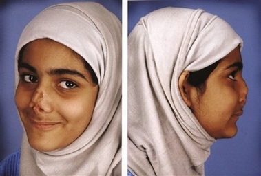 12-year-old Iraqi girl gets new nose in LA