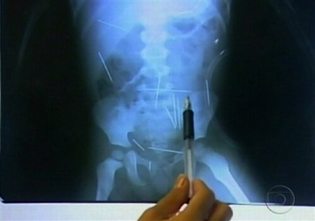 Brazil toddler has 50 needles inside body