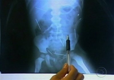 Brazil police: Needles in boy reportedly a ritual