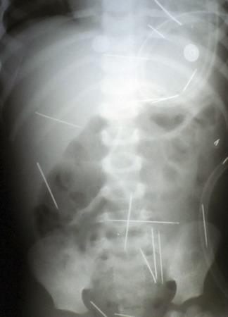 Brazilian says needles were meant to kill stepson