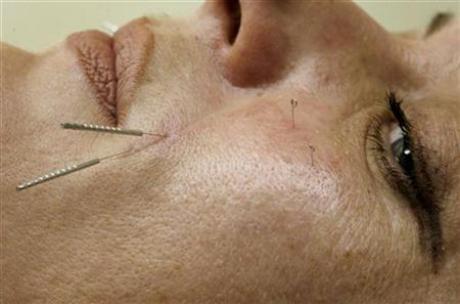 Acupuncture can spread serious diseases: experts
