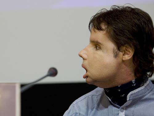 First full face transplant recipient leaves hospital