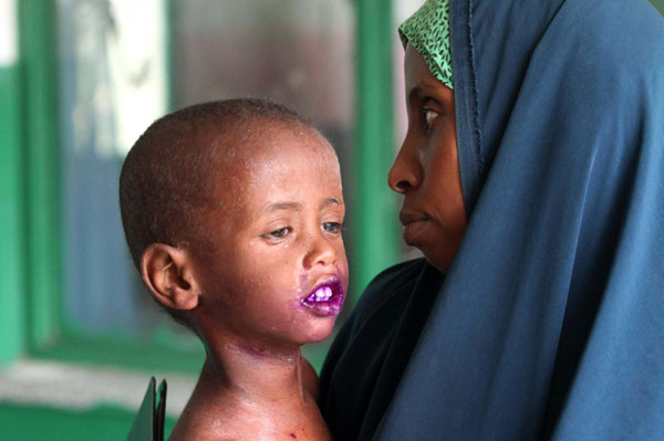 Hundreds dying daily as famine spreads in Somalia -UN