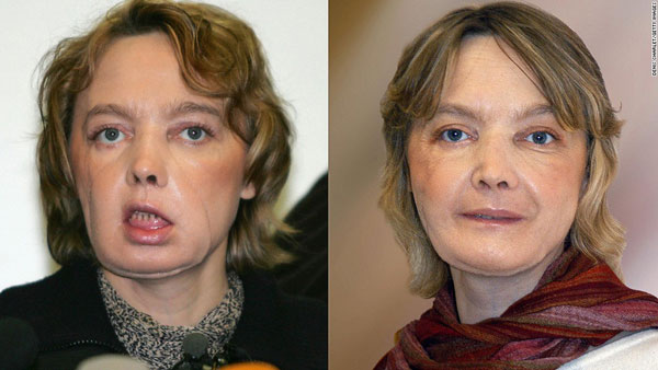 First face transplant recipient dies at age 49