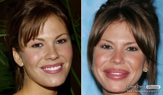 Worst celebrity plastic surgery fails