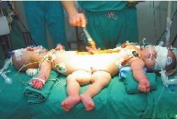 Conjoined twins separated by 33 medics