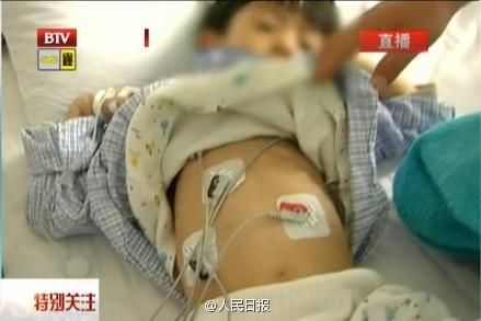 Severe mercury poisoning found in 5-year-old boy