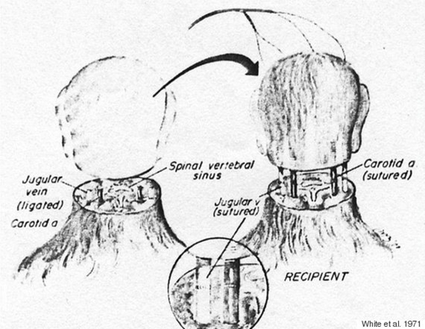 First human head transplant may be carried out in 2017 in China