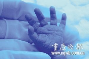 重庆最袖珍婴儿仅重610克 脑袋仅有鹅蛋大