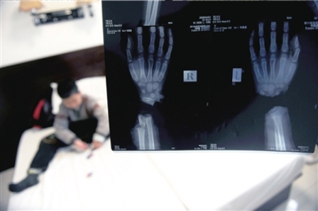 九龄童被养母砍断手扔茅坑 进京求医盼激活手腕