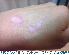 使用后肤色不均 日本佳丽宝召回54种美白化妆品（图）