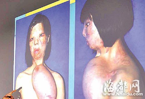 莆田毁容仙女到手“换脸” 浅笑重回脸上