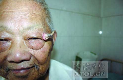 八旬老人眼角长