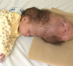 Baby born with 2nd head to get surgery