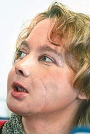 Face transplant patient shows features