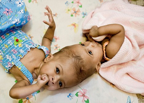 英国医生成功分离头部相连双胞胎女婴 属世界首次