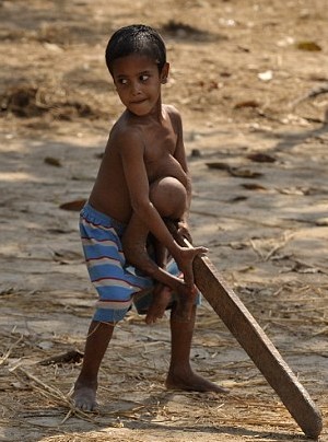 印度“章鱼男孩”术后开心亮相 曾长有四条胳膊四条腿
