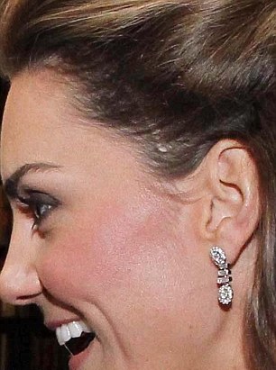 英王妃凯特曾做脑部手术？ 近8厘米伤疤清晰可见