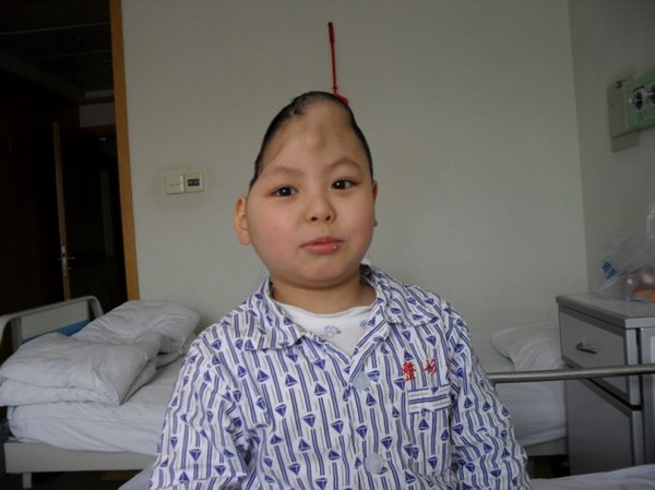 Miracle surgery for boy who lost half skull