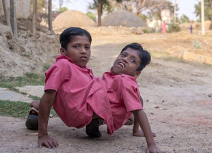 印度连体兄弟被奉为神灵 坦言不想被分离