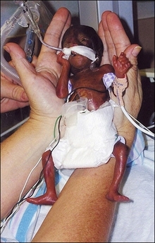 World's most premature living baby