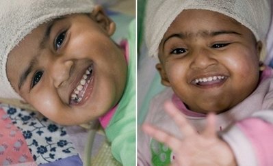 Formerly conjoined twins leave intensive care