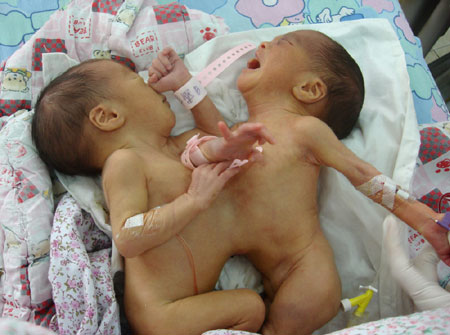 一对连体弃婴在广州得到成功救治